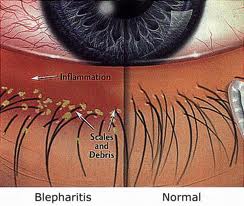 blepharitis-pictoral